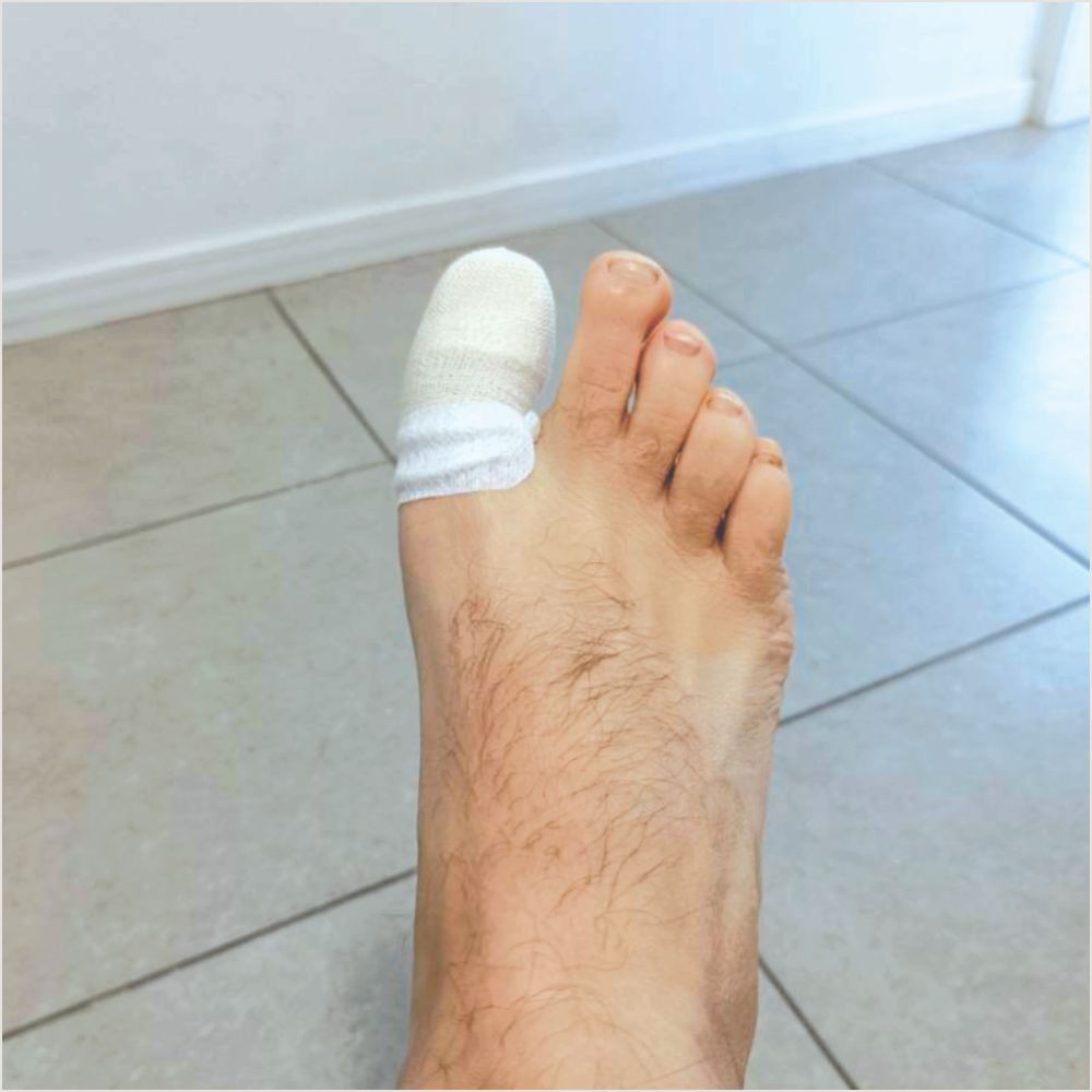 in grown toenail treatment